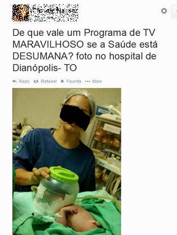 Em Dianópolis, hospital improvisa atendimento de recém-nascido com pote de plástico