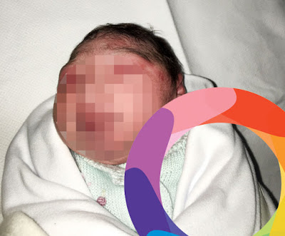 Criança com microcefalia nasce em clínica de Goiânia