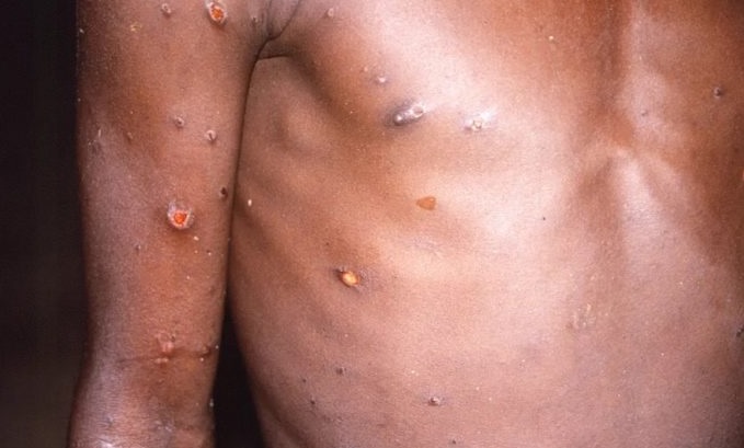 “Nova peste”: América do Sul confirma primeiro caso de varíola do macaco