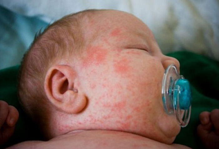 Irresponsabilidade de pais, faz campanha Nacional de Vacinação contra sarampo ser prorrogada até dia 24 de junho