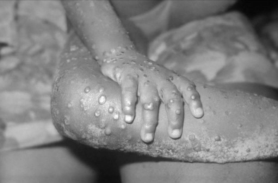 Prefeitura de Goiânia confirma dois casos de varíola de macacos e o DF, seis casos