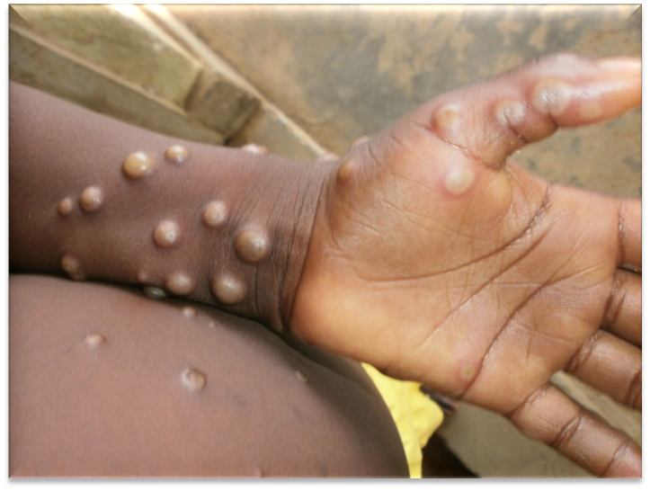 Monkeypox: teste para a doença é incorporado ao Rol 