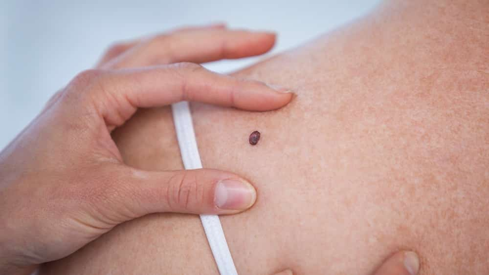 Governo de Goiás disponibiliza consultas e exames para prevenção do câncer de pele