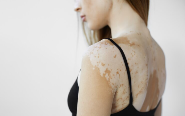 Pele com vitiligo exige cuidados especiais e hidratação reforçada