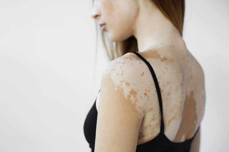 Pele com vitiligo exige cuidados especiais e hidratação reforçada