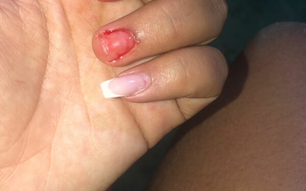 Mãe diz que filha foi severamente agredida e teve  unhas arrancadas, em Arraias (TO)